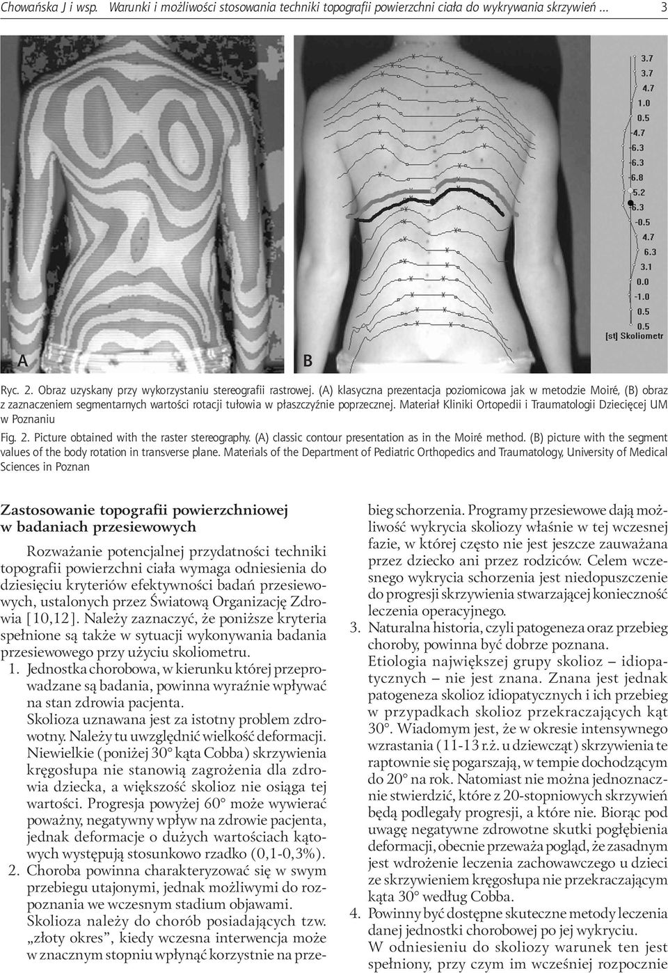 Materiał Kliniki Ortopedii i Traumatologii Dziecięcej UM w Poznaniu Fig. 2. Picture obtained with the raster stereography. (A) classic contour presentation as in the Moiré method.