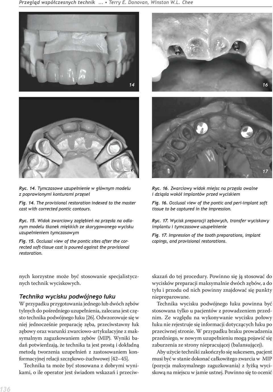Ryc. 16. Zwarciowy widok miejsc na przęsła owalne i dziąsła wokół implantów przed wyciskiem Fig. 16. Occlusal view of the pontic and peri-implant soft tissue to be captured in the impression. Ryc. 17.