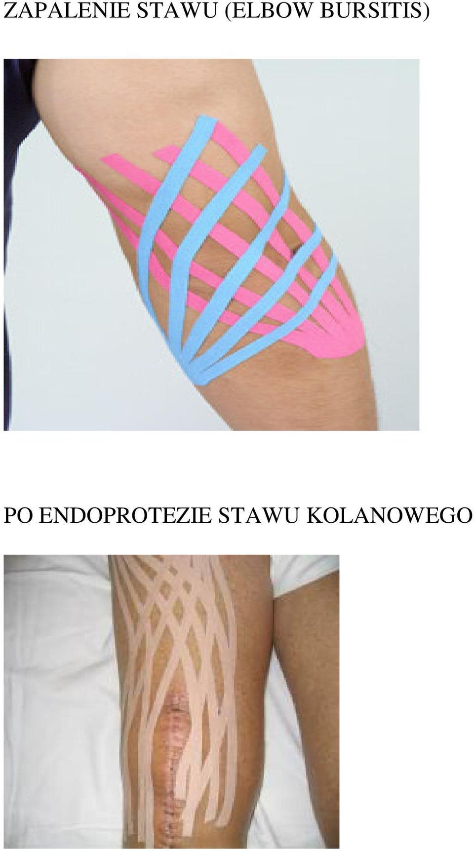 PO ENDOPROTEZIE