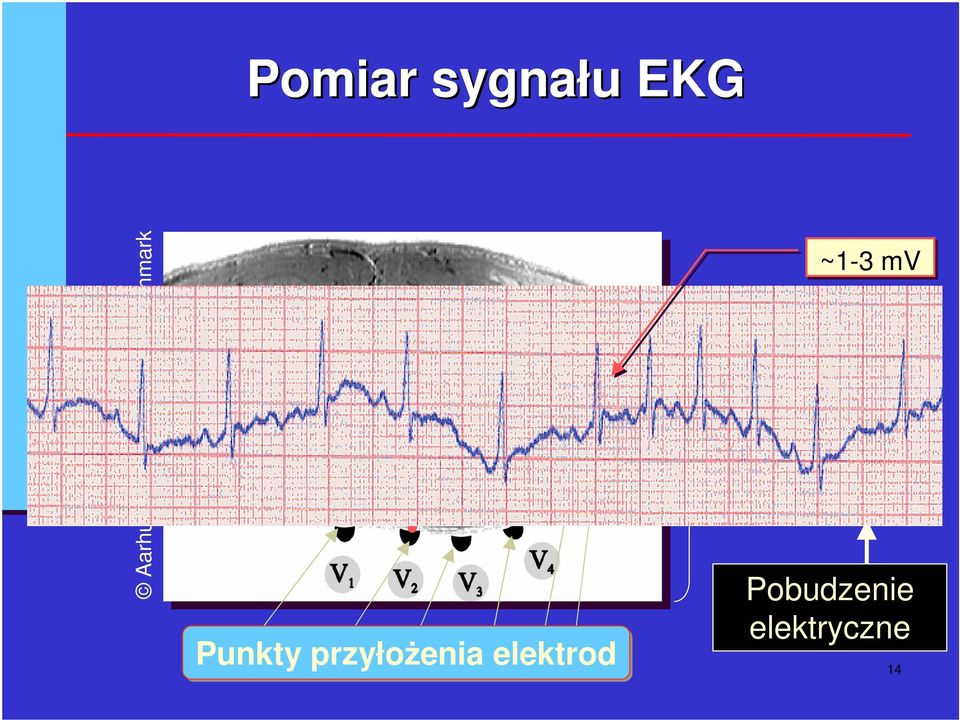 x) RV LV Punkty przyłoenia elektrod