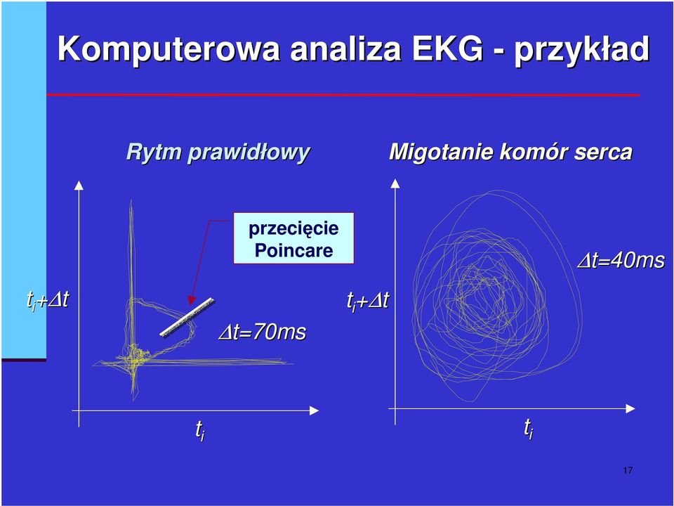 Migotanie komór serca t i + t
