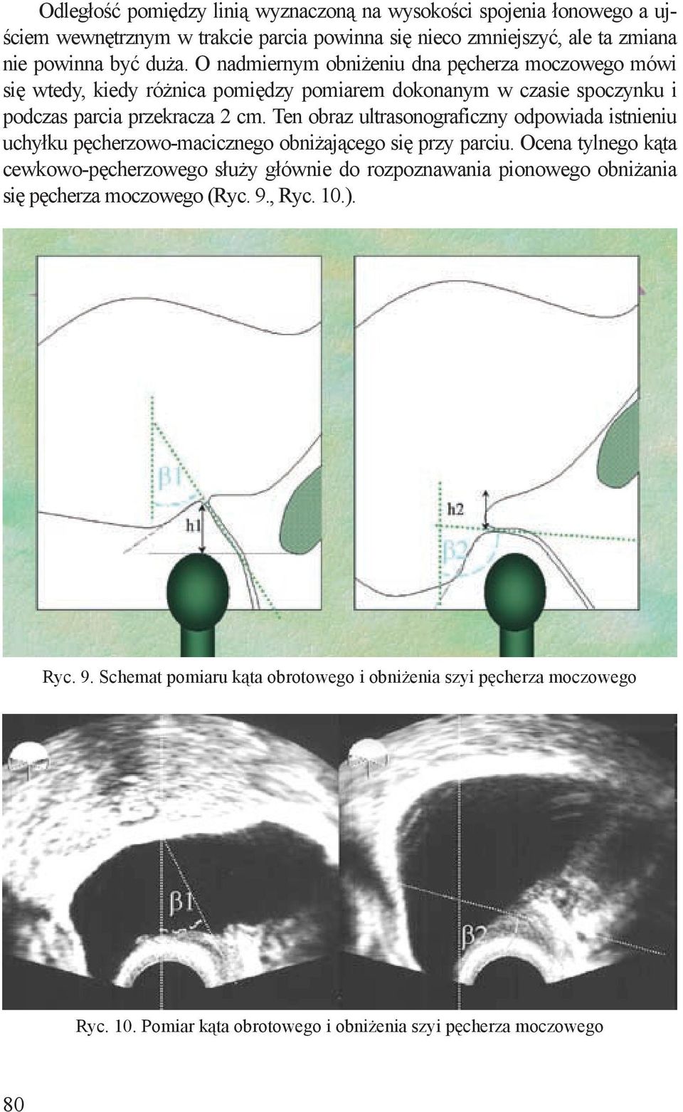 Ten obraz ultrasonograficzny odpowiada istnieniu uchyłku pęcherzowo-macicznego obniżającego się przy parciu.