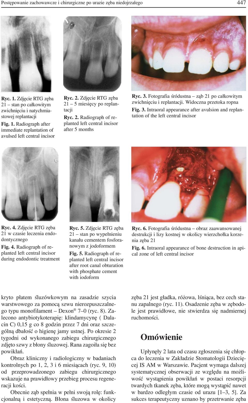 4. Zdjęcie RTG zęba 21 w czasie leczenia endo dontycznego Fig. 4. Radiograph of re during endodontic treatment Ryc. 5.