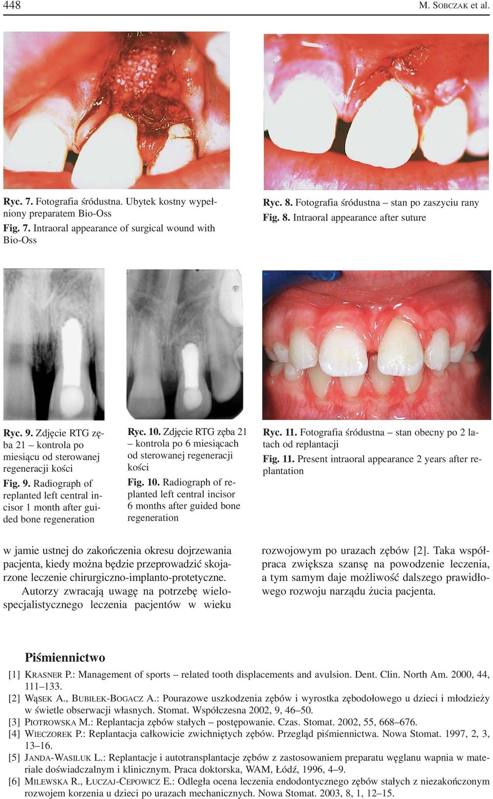 10. Zdjęcie RTG zęba 21 kontrola po 6 miesiącach od sterowanej regeneracji kości Fig. 10. Radiograph of re 6 months after guided bone regeneration Ryc. 11.