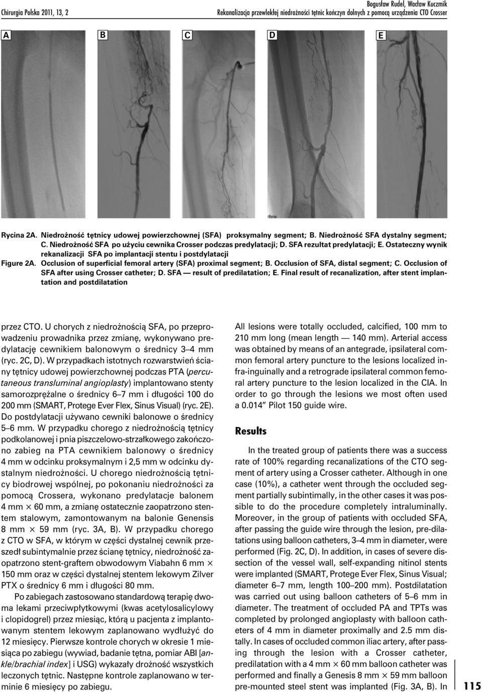 SFA rezultat predylatacji; E. Ostateczny wynik rekanalizacji SFA po implantacji stentu i postdylatacji Figure 2A. Occlusion of superficial femoral artery (SFA) proximal segment; B.