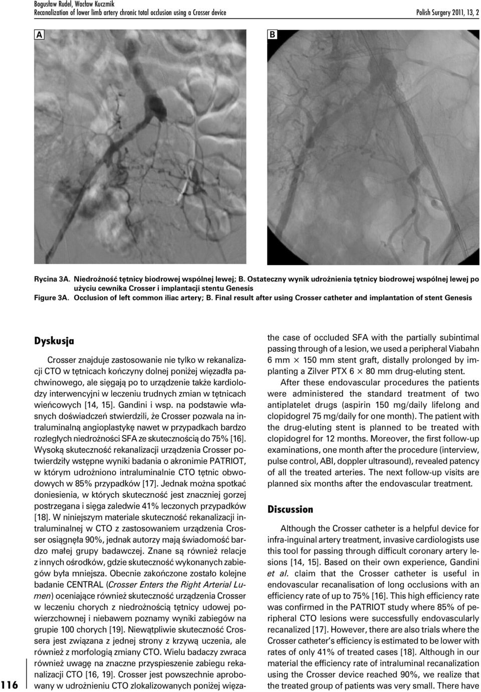 Occlusion of left common iliac artery; B.