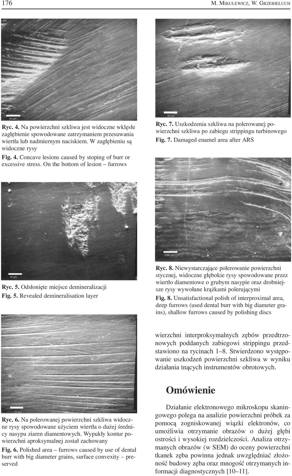 Uszkodzenia szkliwa na polerowanej po wierzchni szkliwa po zabiegu strippingu turbinowego Fig. 7. Damaged enamel area after ARS Ryc. 5. Odsłonięte miejsce demineralizacji Fig. 5. Revealed demineralisation layer Ryc.