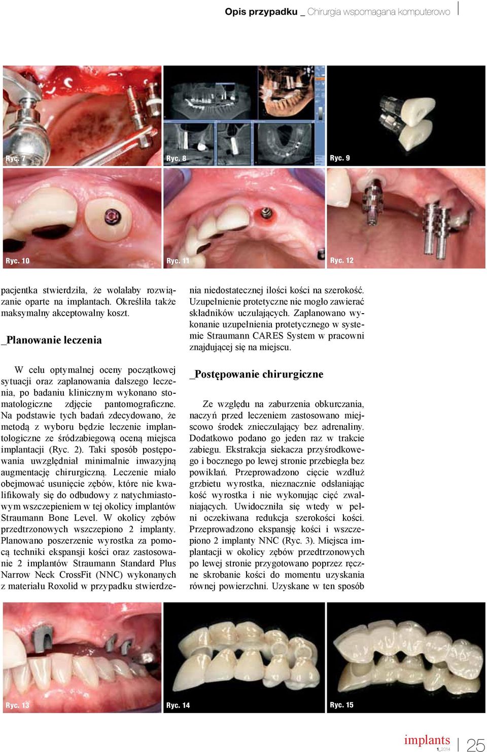 _Planowanie leczenia W celu optymalnej oceny początkowej sytuacji oraz zaplanowania dalszego leczenia, po badaniu klinicznym wykonano stomatologiczne zdjęcie pantomograficzne.