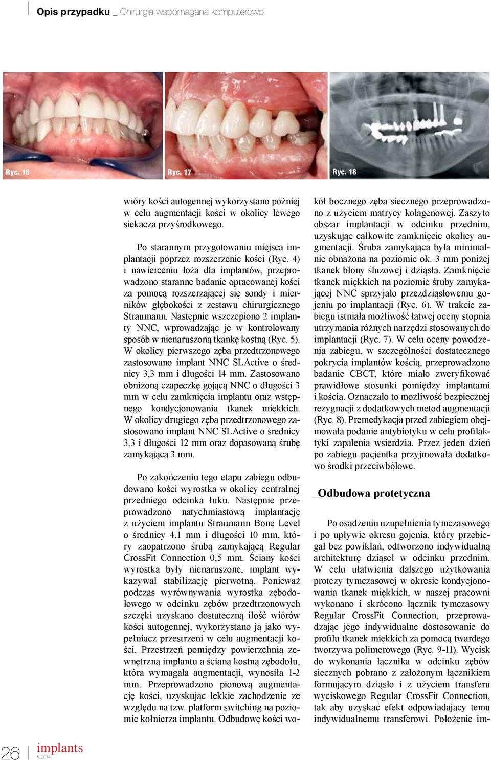 4) i nawierceniu łoża dla implantów, przeprowadzono staranne badanie opracowanej kości za pomocą rozszerzającej się sondy i mierników głębokości z zestawu chirurgicznego Straumann.