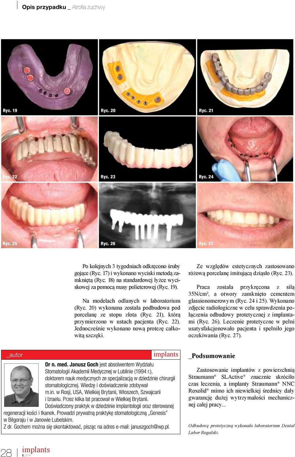 20) wykonana została podbudowa pod porcelanę ze stopu złota (Ryc. 21), którą przymierzono w ustach pacjenta (Ryc. 22). Jednocześnie wykonano nową protezę całkowitą szczęki.