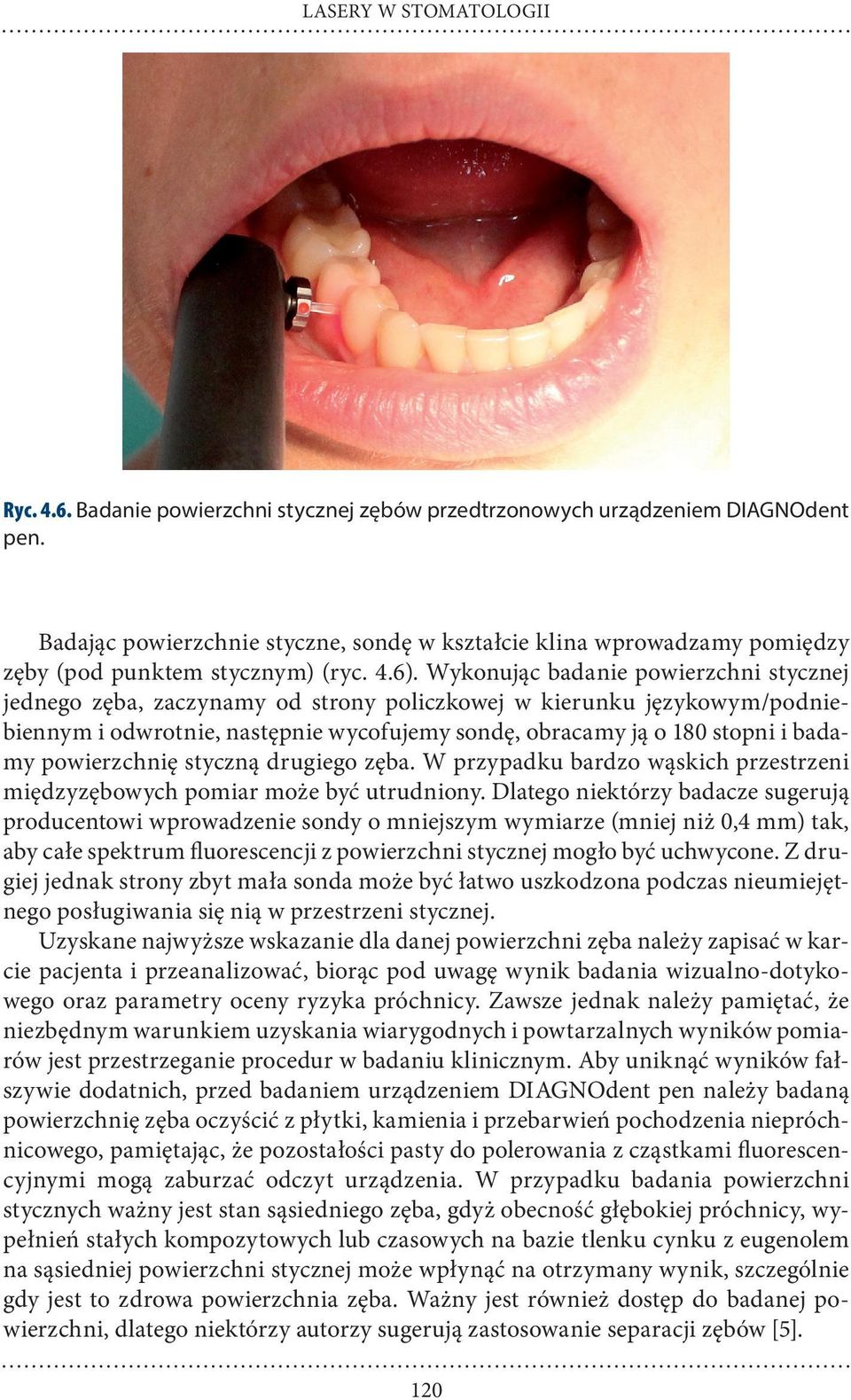 Wykonując badanie powierzchni stycznej jednego zęba, zaczynamy od strony policzkowej w kierunku językowym/podniebiennym i odwrotnie, następnie wycofujemy sondę, obracamy ją o 180 stopni i badamy