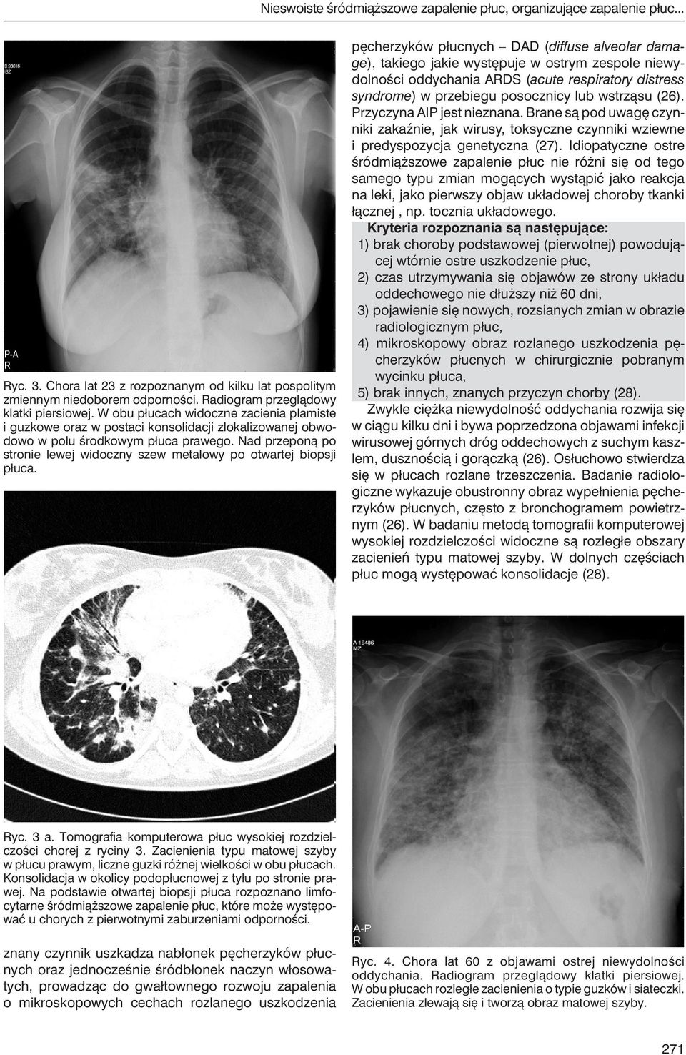 Nad przeponą po stronie lewej widoczny szew metalowy po otwartej biopsji płuca.