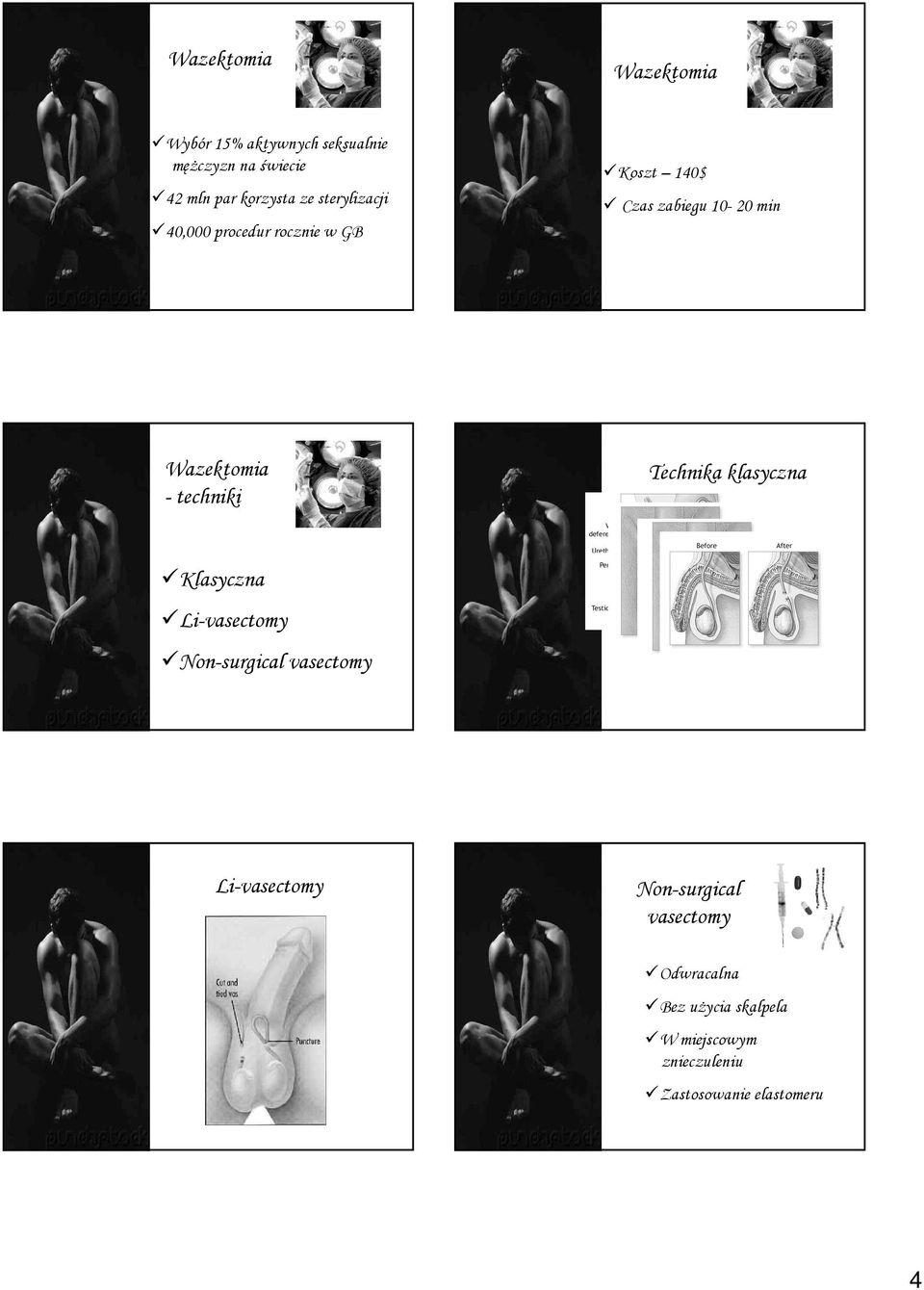 techniki Technika klasyczna Klasyczna Li-vasectomy Non-surgical vasectomy Li-vasectomy