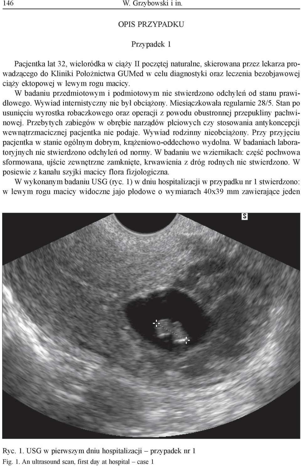 ciąży ektopowej w lewym rogu macicy. W badaniu przedmiotowym i podmiotowym nie stwierdzono odchyleń od stanu prawidłowego. Wywiad internistyczny nie był obciążony. Miesiączkowała regularnie 28/5.