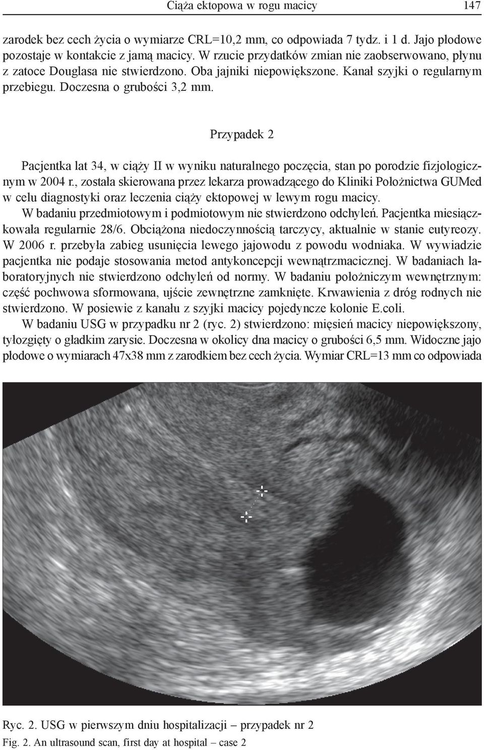 Przypadek 2 Pacjentka lat 34, w ciąży II w wyniku naturalnego poczęcia, stan po porodzie fizjologicznym w 2004 r.