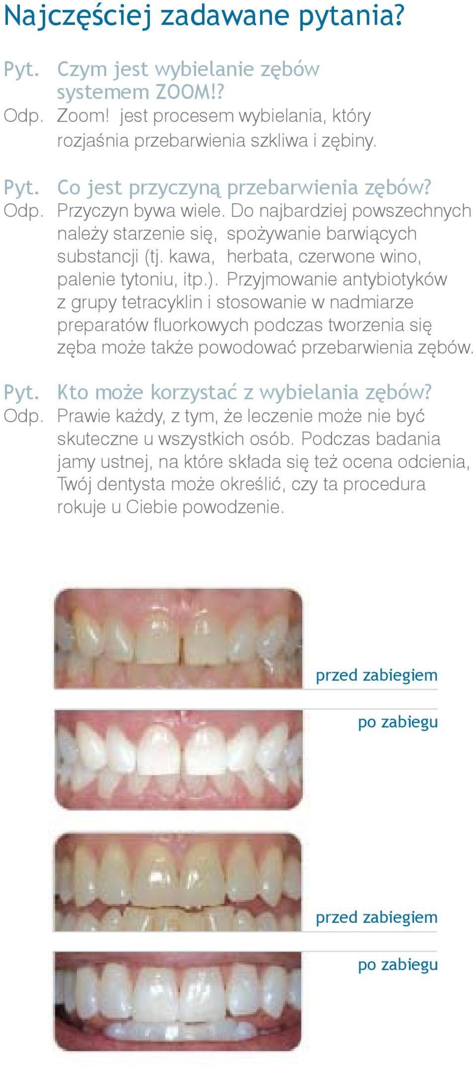 Przyjmowanie antybiotyków z grupy tetracyklin i stosowanie w nadmiarze preparatów fluorkowych podczas tworzenia się zęba może także powodować przebarwienia zębów. Pyt.