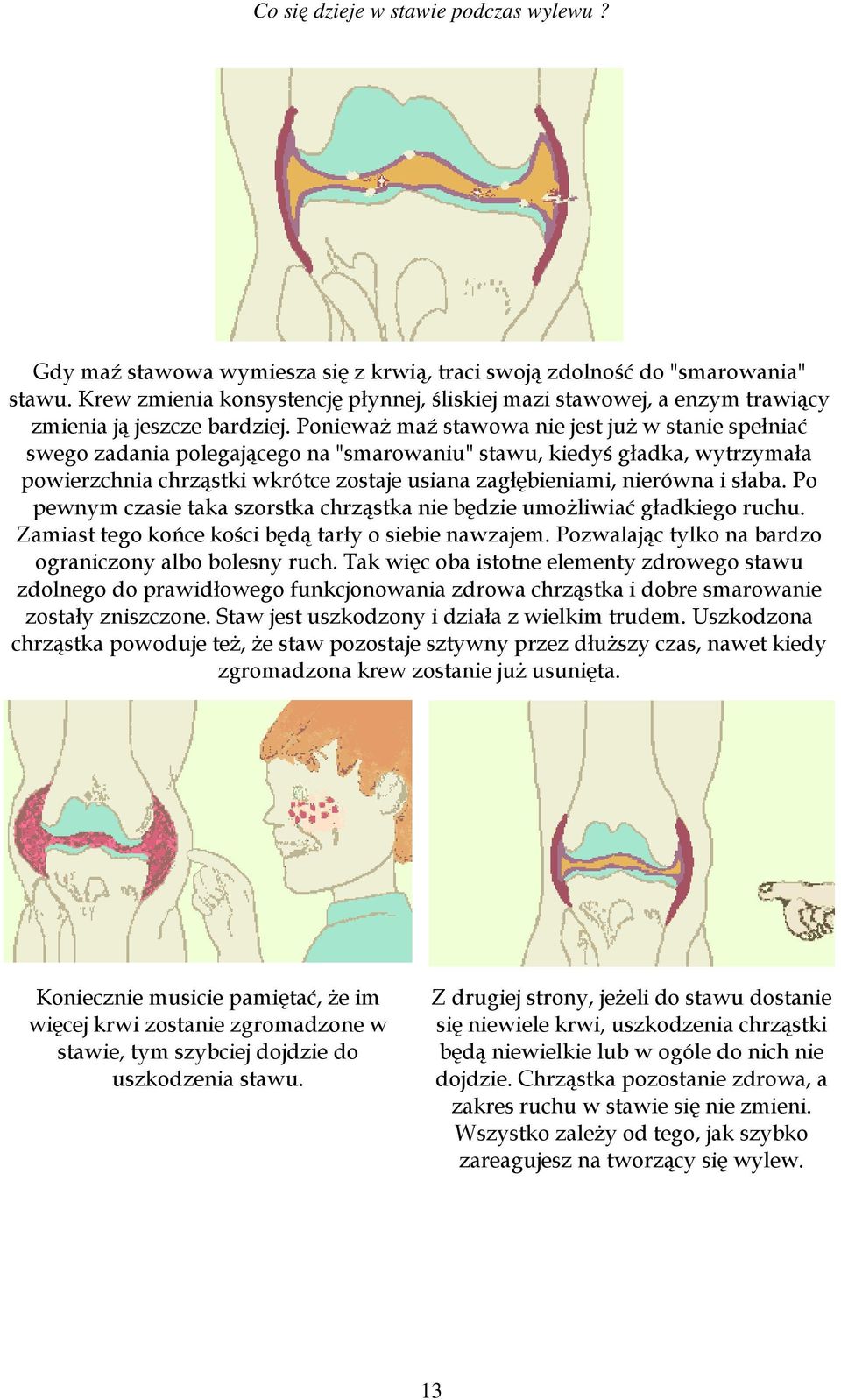słaba. Po pewnym czasie taka szorstka chrząstka nie będzie umożliwiać gładkiego ruchu. Zamiast tego końce kości będą tarły o siebie nawzajem. Pozwalając tylko na bardzo ograniczony albo bolesny ruch.