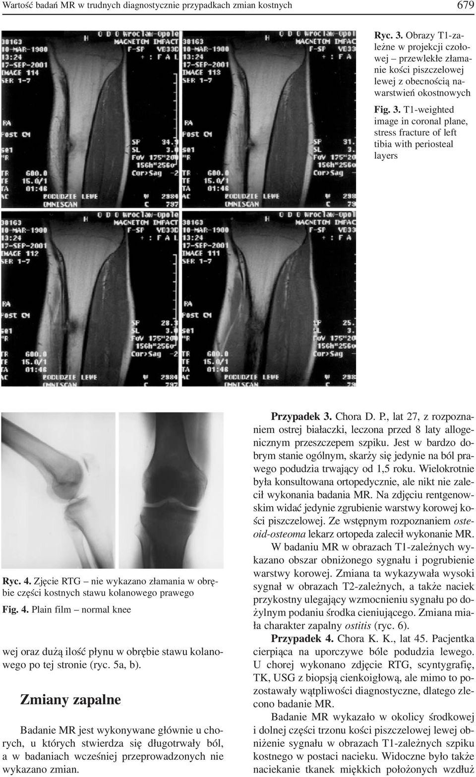 T1 weighted image in coronal plane, stress fracture of left tibia with periosteal layers Ryc. 4. Zjęcie RTG nie wykazano złamania w obrę bie części kostnych stawu kolanowego prawego Fig. 4. Plain film normal knee wej oraz dużą ilość płynu w obrębie stawu kolano wego po tej stronie (ryc.