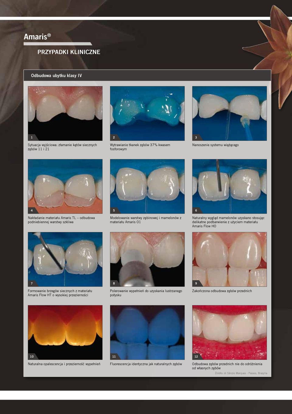 użyciem materiału Amaris Flow HO 7 Formowanie brzegów siecznych z materiału Amaris Flow HT o wysokiej przezierności 8 Polerowanie wypełnień do uzyskania lustrzanego połysku 9 Zakończona odbudowa
