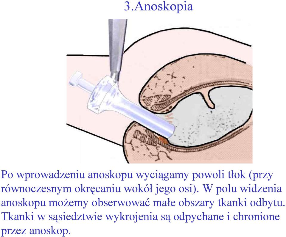 W polu widzenia anoskopu możemy obserwować małe obszary