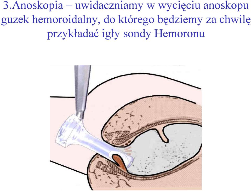 hemoroidalny, do którego