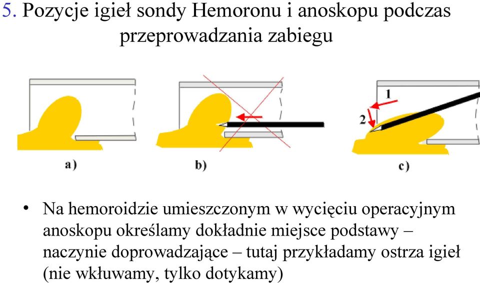 operacyjnym anoskopu określamy dokładnie miejsce podstawy