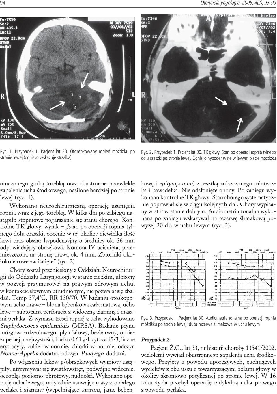 Ognisko hypodensyjne w lewym p³acie mó d ku otoczonego grub¹ torebk¹ oraz obustronne przewlekle zapalenia ucha œrodkowego, nasilone bardziej po stronie lewej (ryc. 1).