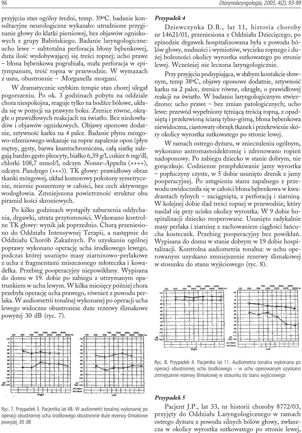 Badanie laryngologiczne: ucho lewe subtotalna perforacja b³ony bêbenkowej, du a iloœæ wydobywaj¹cej siê treœci ropnej; ucho prawe b³ona bêbenkowa pogrubia³a, ma³a perforacja w epitympanum, treœæ