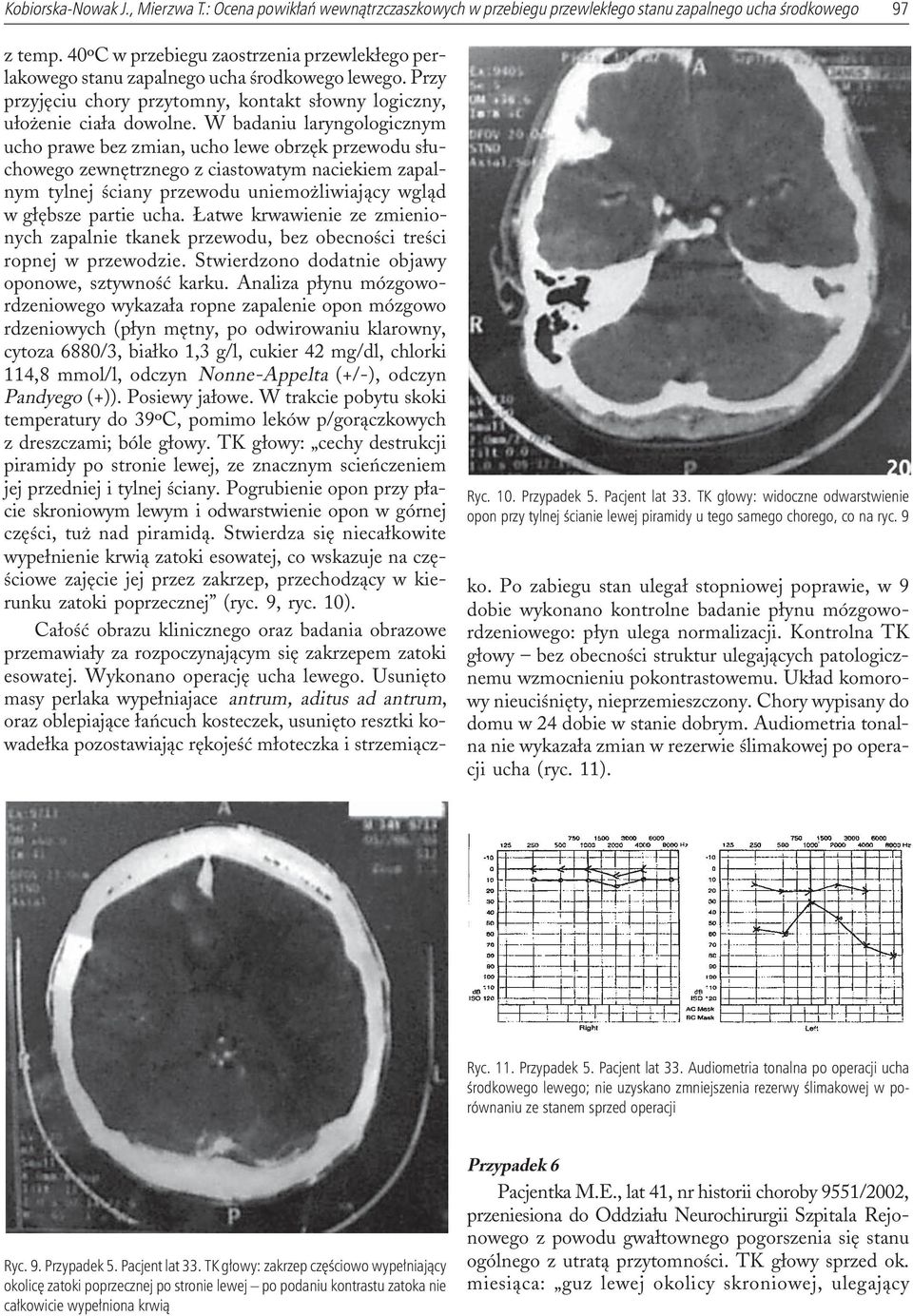 W badaniu laryngologicznym ucho prawe bez zmian, ucho lewe obrzêk przewodu s³uchowego zewnêtrznego z ciastowatym naciekiem zapalnym tylnej œciany przewodu uniemo liwiaj¹cy wgl¹d w g³êbsze partie ucha.