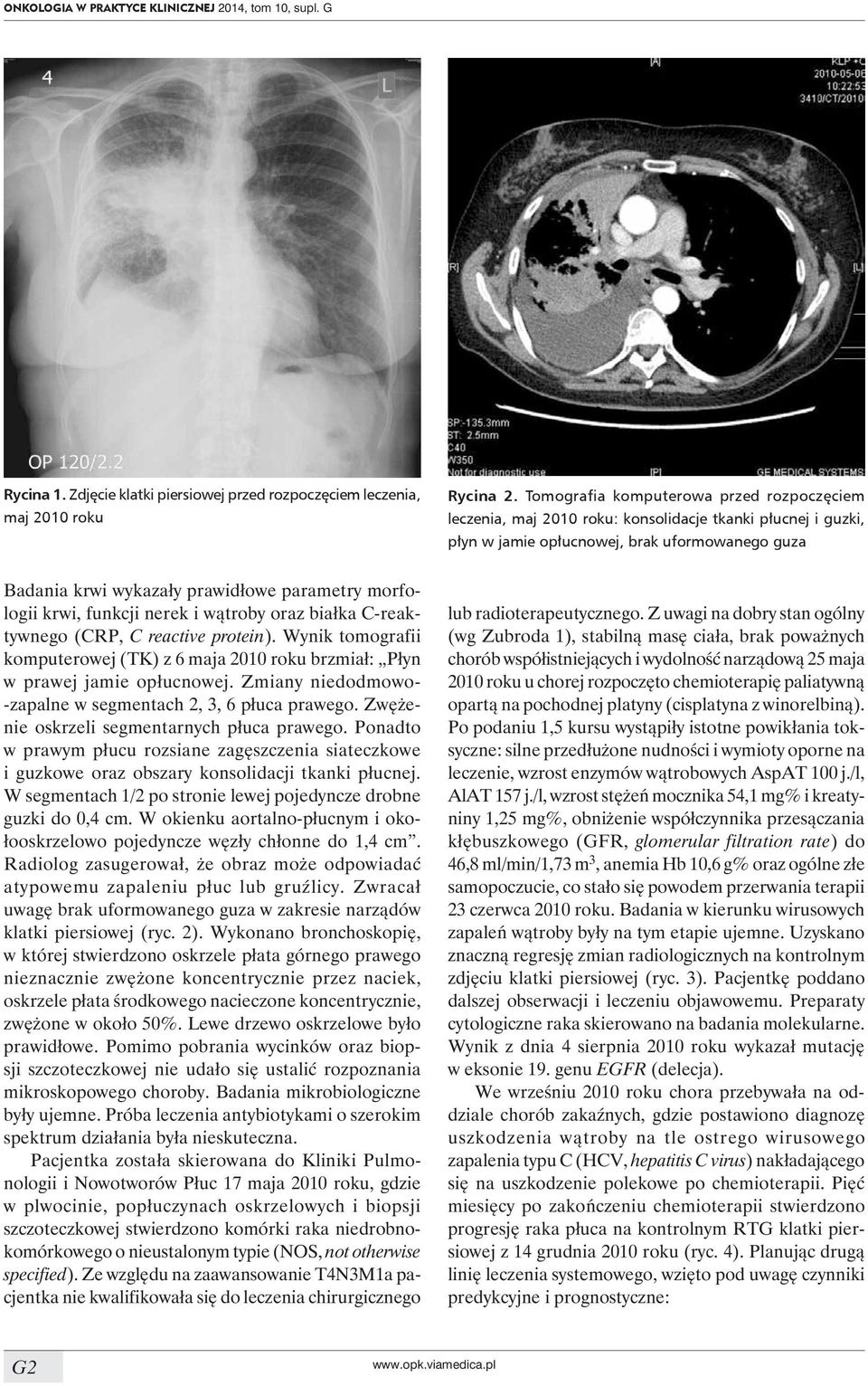 morfologii krwi, funkcji nerek i wątroby oraz białka C-reaktywnego (CRP, C reactive protein). Wynik tomografii komputerowej (TK) z 6 maja 2010 roku brzmiał: Płyn w prawej jamie opłucnowej.