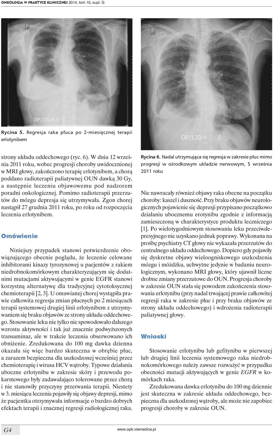 objawowemu pod nadzorem poradni onkologicznej. Pomimo radioterapii przerzutów do mózgu depresja się utrzymywała. Zgon chorej nastąpił 27 grudnia 2011 roku, po roku od rozpoczęcia leczenia erlotynibem.