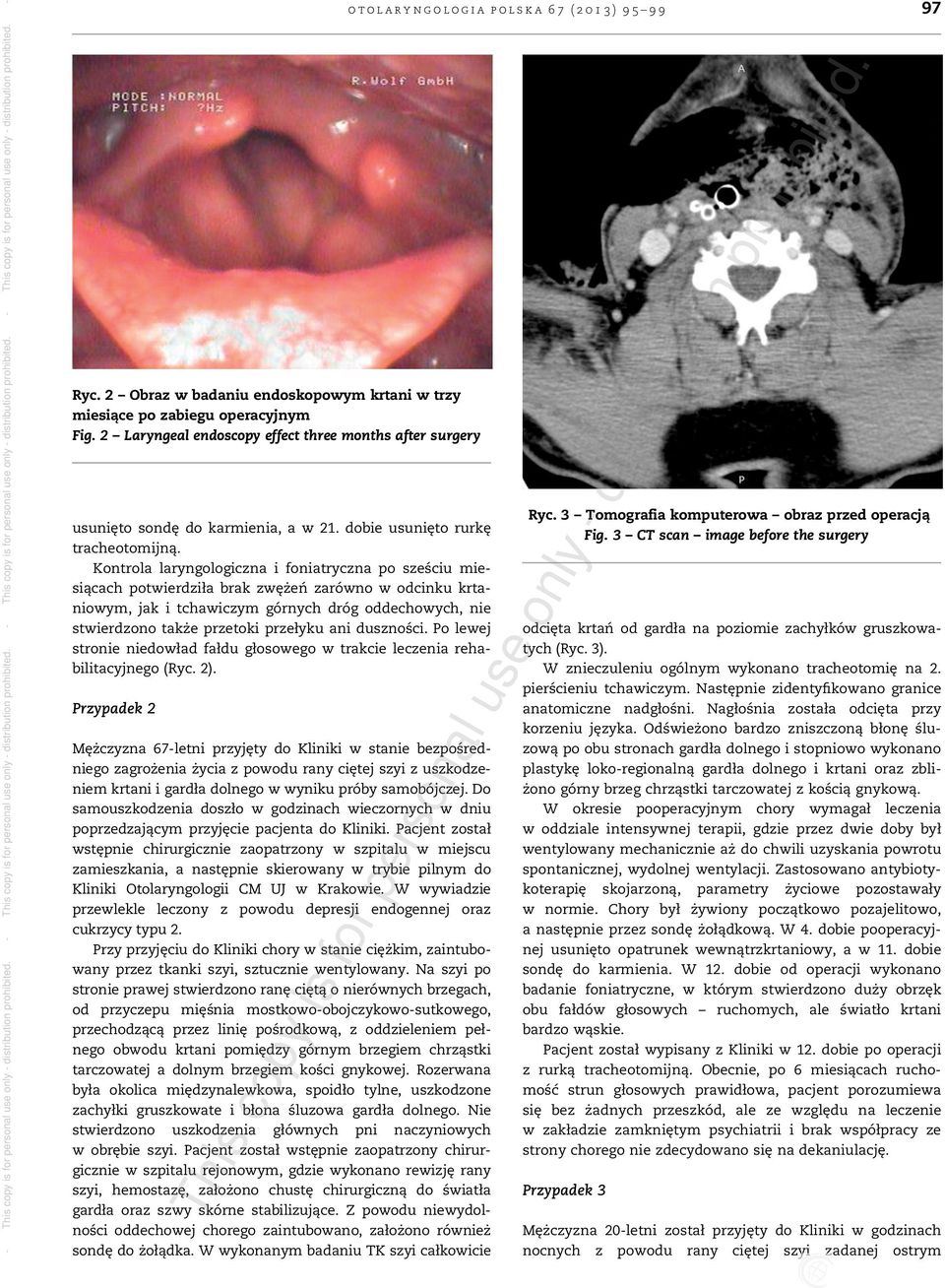 Kontrola laryngologiczna i foniatryczna po sześciu miesiącach potwierdziła brak zwężeń zarówno w odcinku krtaniowym, jak i tchawiczym górnych dróg oddechowych, nie stwierdzono także przetoki przełyku