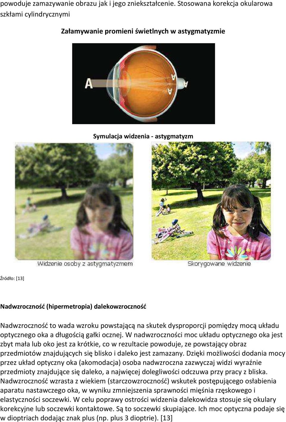 Nadwzroczność to wada wzroku powstającą na skutek dysproporcji pomiędzy mocą układu optycznego oka a długością gałki ocznej.