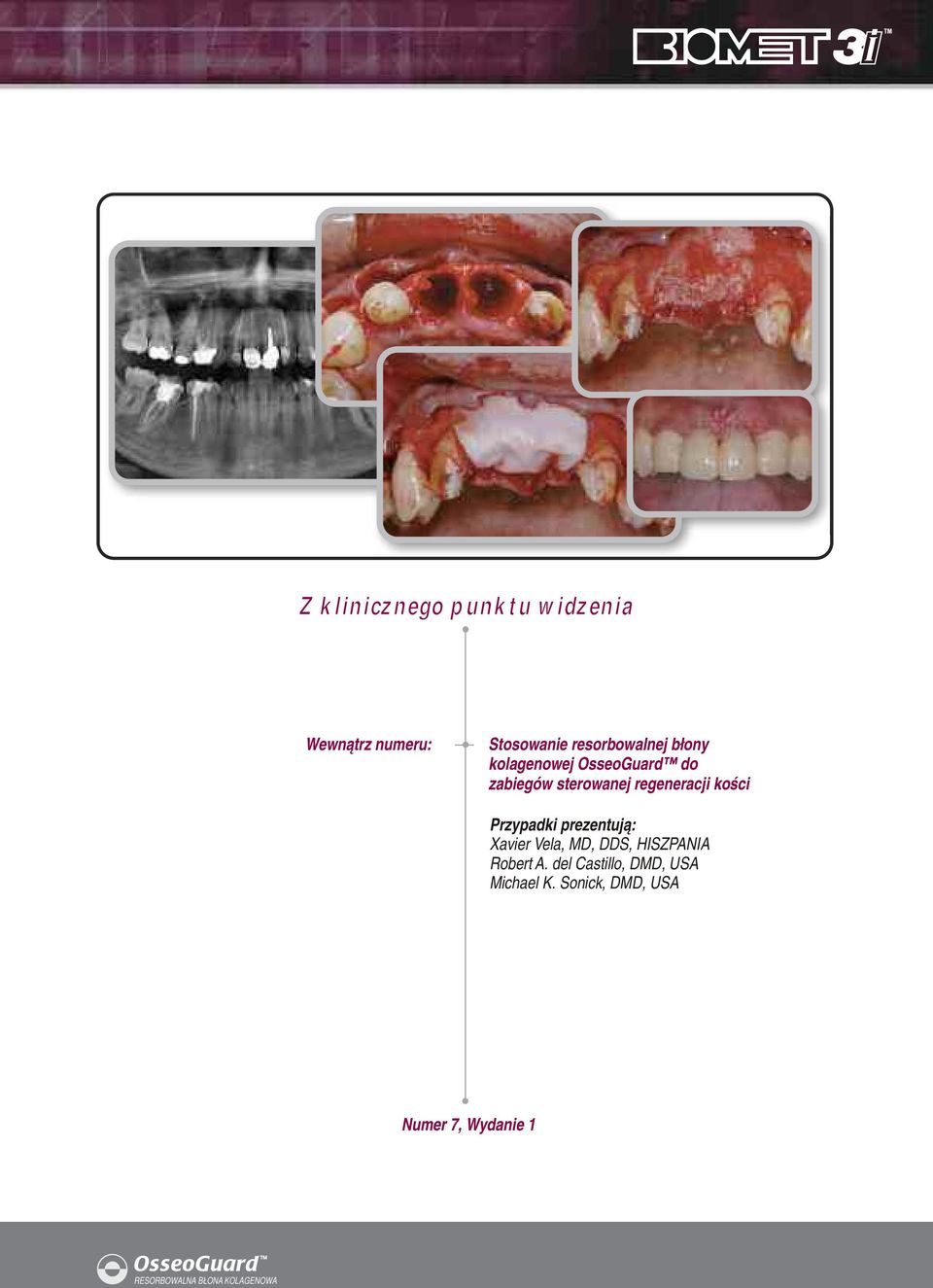 Przypadki prezentują: Xavier Vela, MD, DDS, HISZPANIA Robert A.