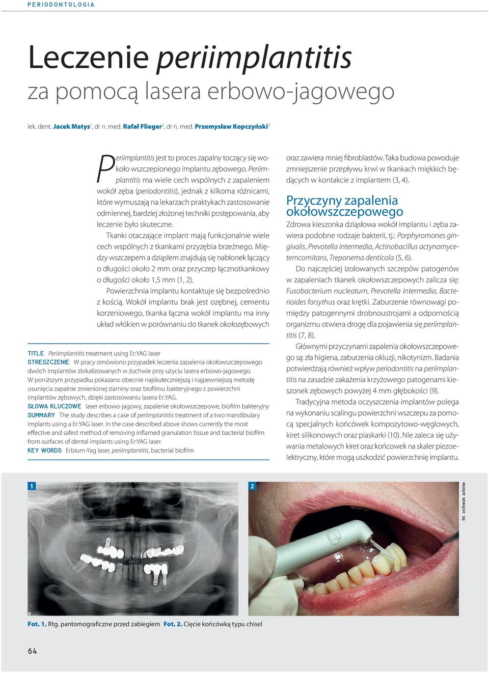 Periimplantitis ma wiele cech wspólnych z zapaleniem wokół zęba (periodontitis), jednak z kilkoma różnicami, które wymuszają na lekarzach praktykach zastosowanie odmiennej, bardziej złożonej techniki