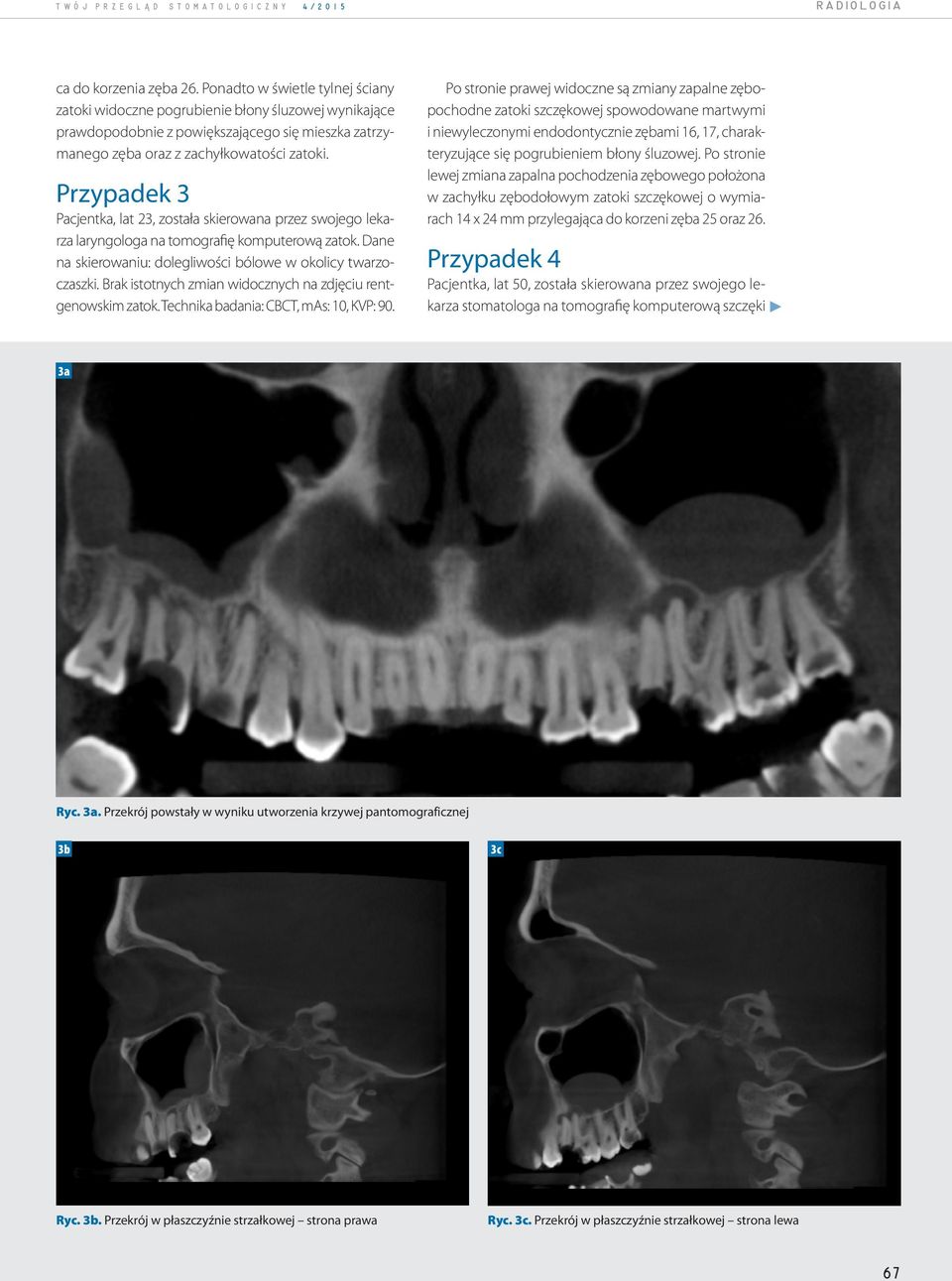 Przypadek 3 Pacjentka, lat 23, została skierowana przez swojego lekarza laryngologa na tomografię komputerową zatok. Dane na skierowaniu: dolegliwości bólowe w okolicy twarzoczaszki.