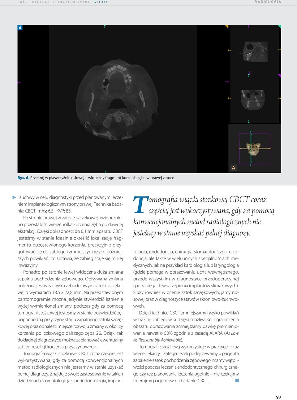 radiologicznych nie jesteśmy w stanie uzyskać pełnej diagnozy. i żuchwy w celu diagnostyki przed planowanym leczeniem implantologicznym strony prawej. Technika badania: CBCT, mas: 6,5, KVP: 85.