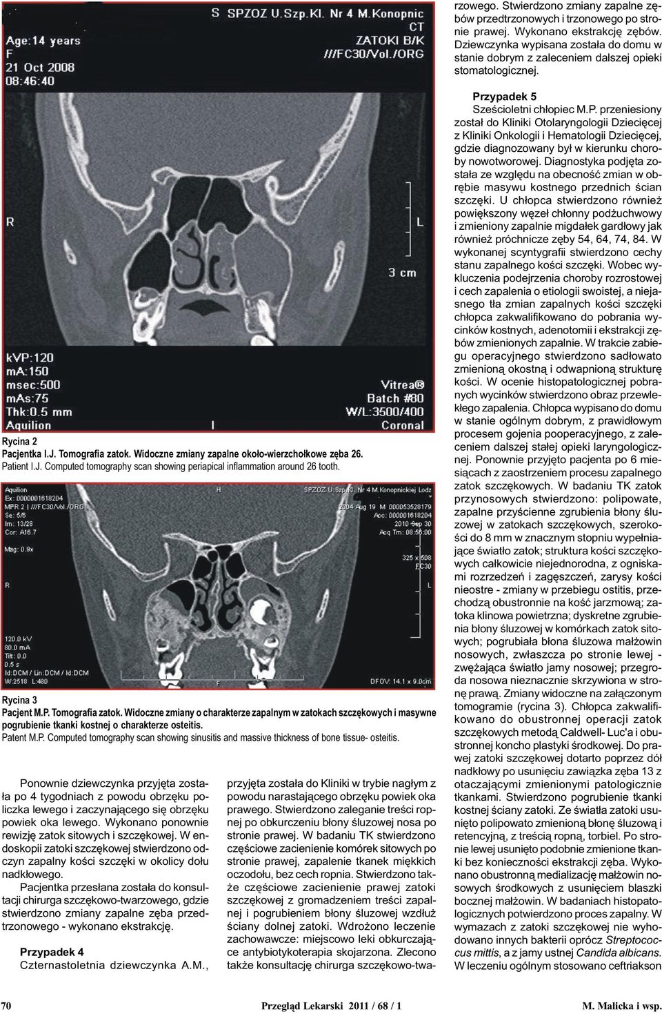 Patient I.J. Computed tomography scan showing periapical inflammation around 26 tooth. Rycina 3 Pacjent M.P. Tomografia zatok.