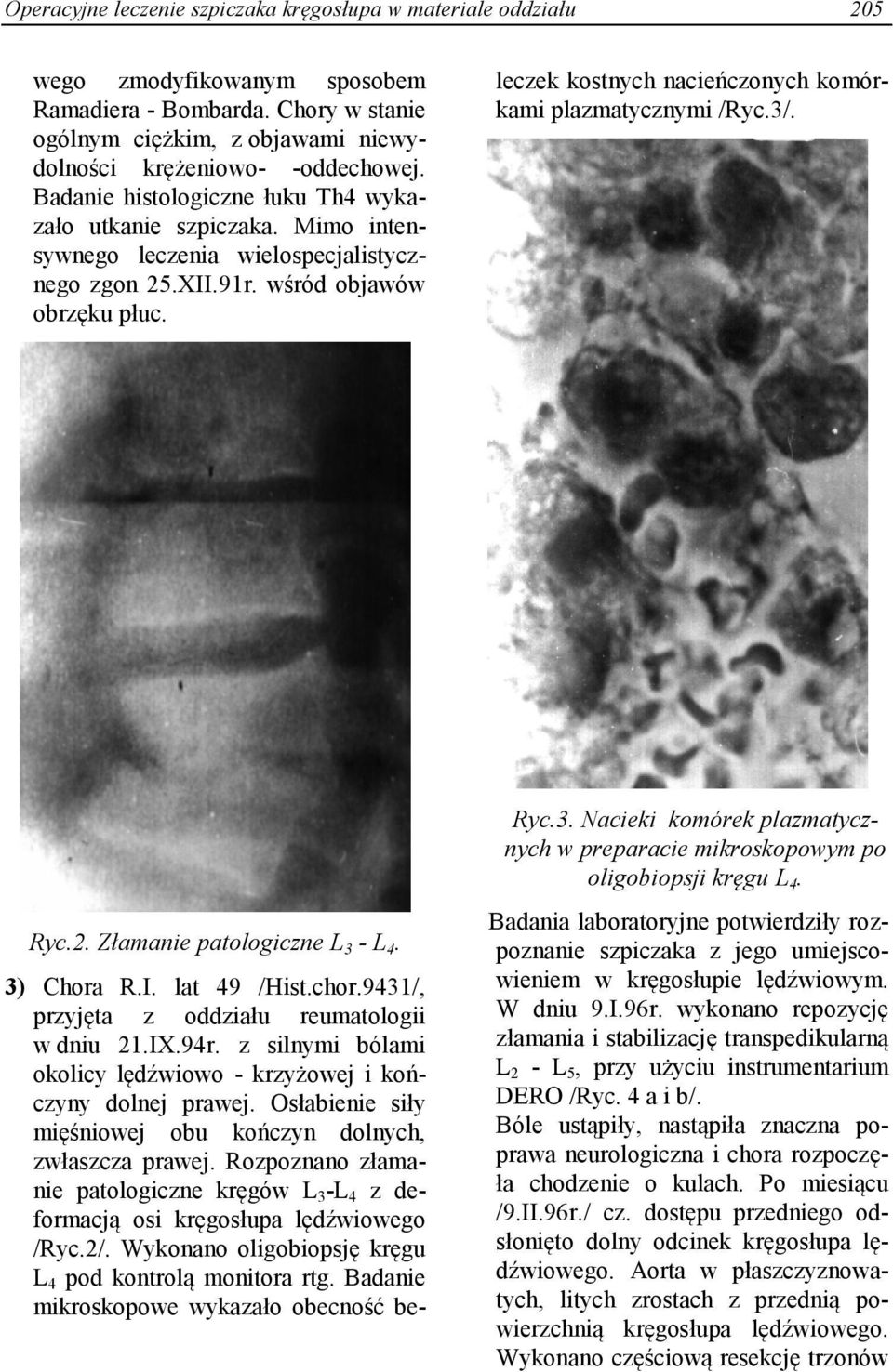 9431/, przyjęta z oddziału reumatologii w dniu 21.IX.94r. z silnymi bólami okolicy lędźwiowo - krzyżowej i kończyny dolnej prawej. Osłabienie siły mięśniowej obu kończyn dolnych, zwłaszcza prawej.