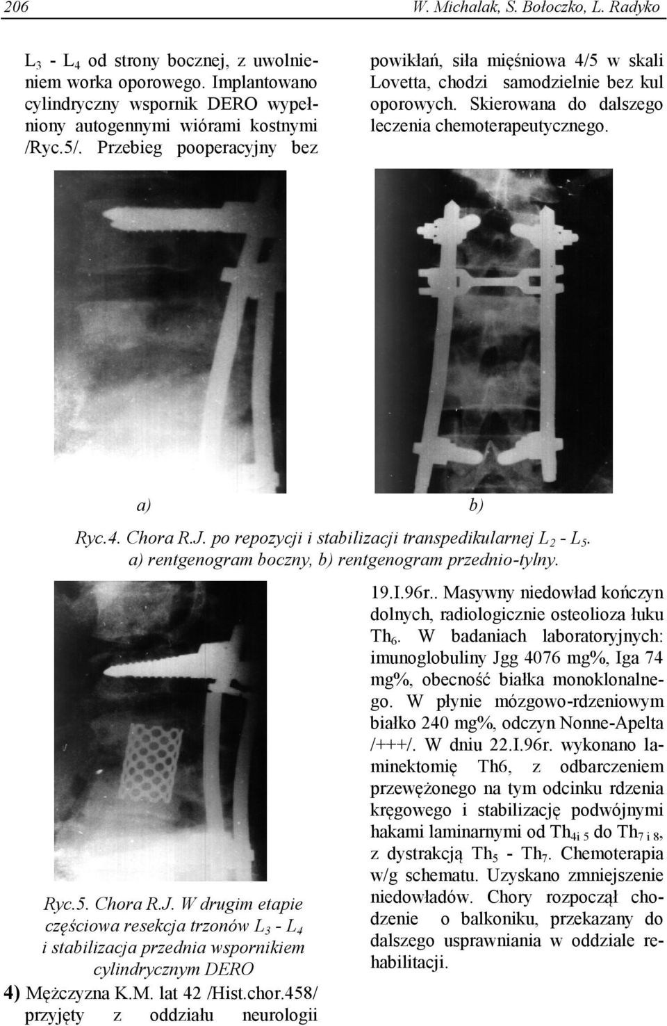po repozycji i stabilizacji transpedikularnej L 2 - L 5. a) rentgenogram boczny, b) rentgenogram przednio-tylny. Ryc.5. Chora R.J.
