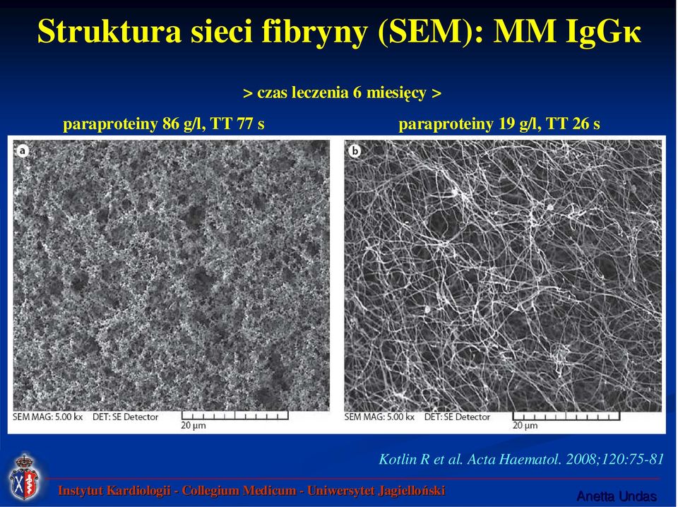 g/l, TT 77 s paraproteiny 19 g/l, TT 26 s
