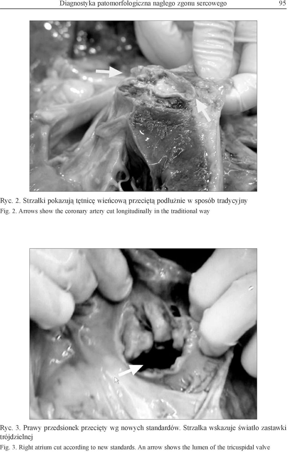 Arrows show the coronary artery cut longitudinally in the traditional way Ryc. 3.