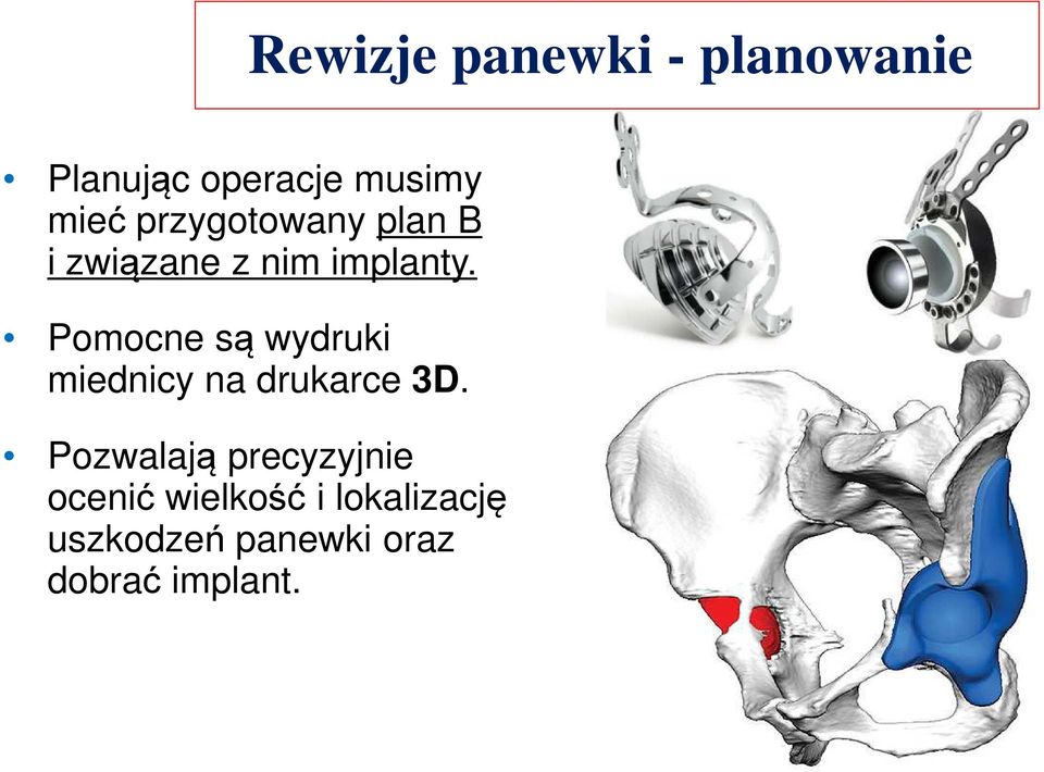 Pomocne są wydruki miednicy na drukarce 3D.