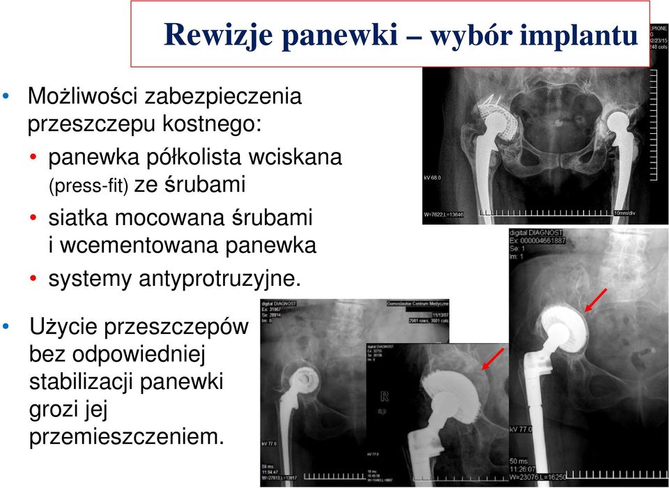 mocowana śrubami i wcementowana panewka systemy antyprotruzyjne.