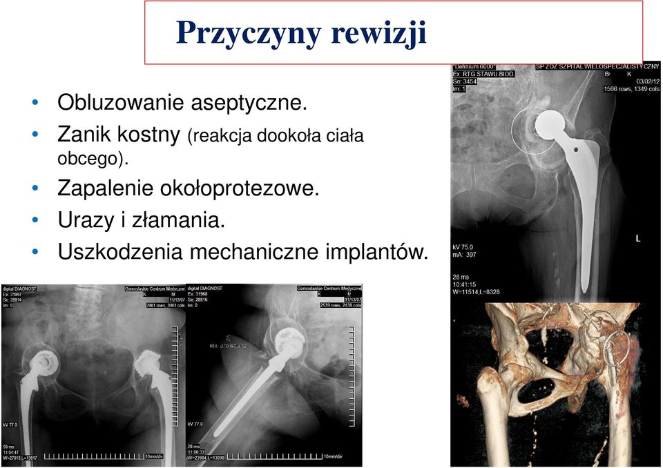 obcego). Zapalenie okołoprotezowe.