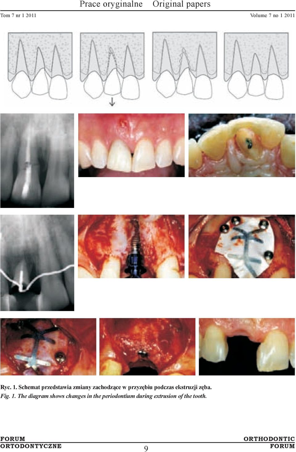 przyzębiu podczas ekstruzji zęba. Fig. 1.