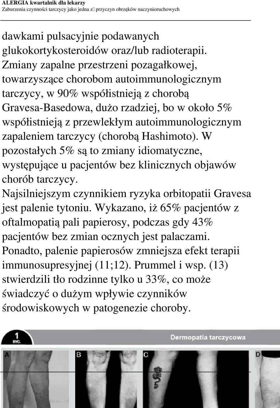 autoimmunologicznym zapaleniem tarczycy (chorobą Hashimoto). W pozostałych 5% są to zmiany idiomatyczne, występujące u pacjentów bez klinicznych objawów chorób tarczycy.