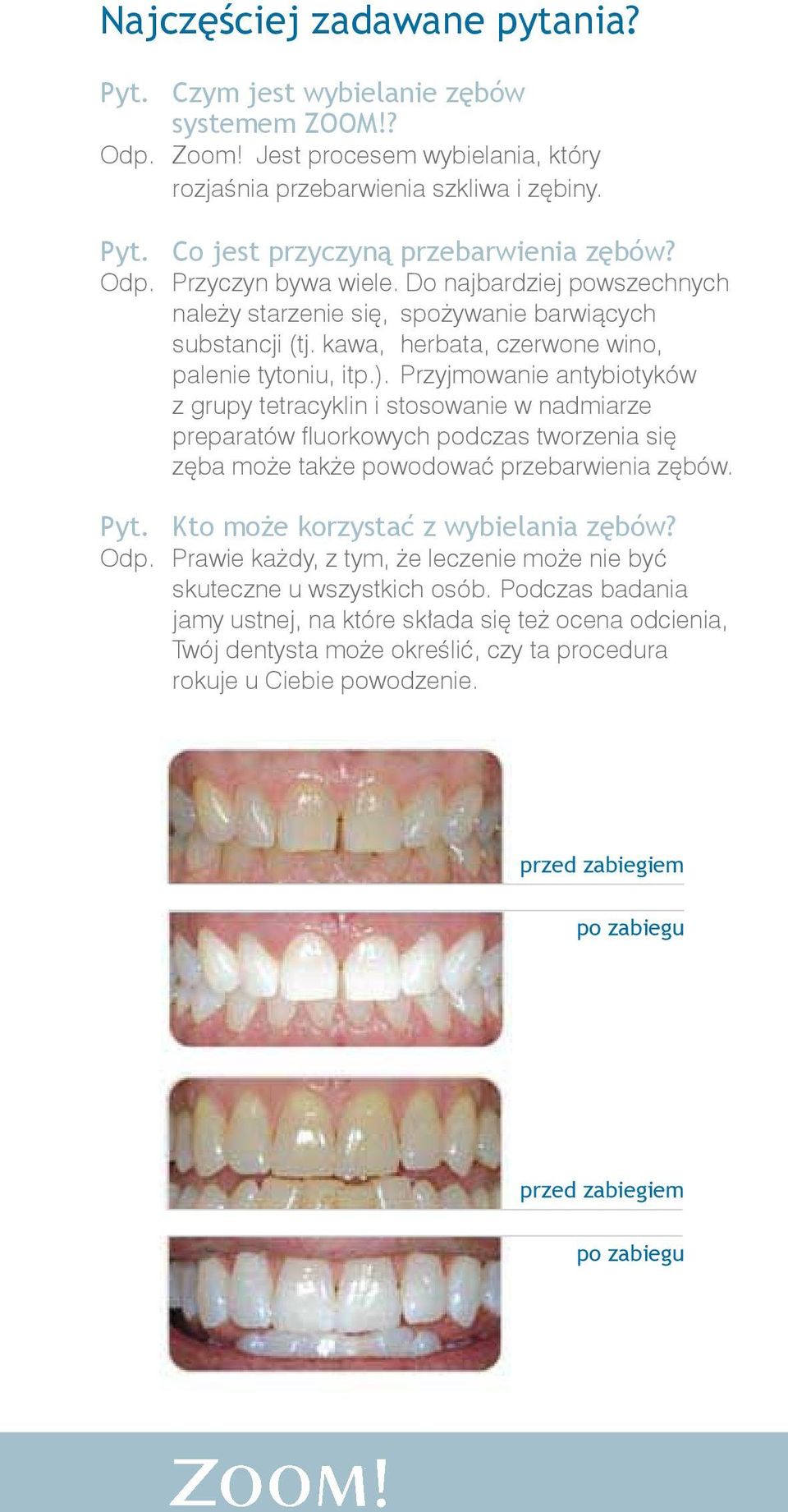 Przyjmowanie antybiotyków z grupy tetracyklin i stosowanie w nadmiarze preparatów fluorkowych podczas tworzenia się zęba może także powodować przebarwienia zębów. Pyt.