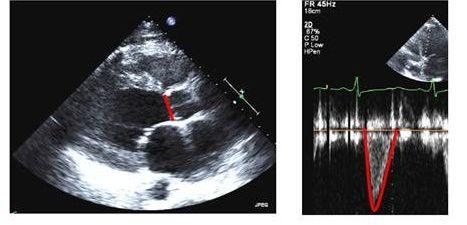 CO (RHC) a CO (DE) CO = VTI LVOT x LVOTd 2 x 0,785 x HR Metoda