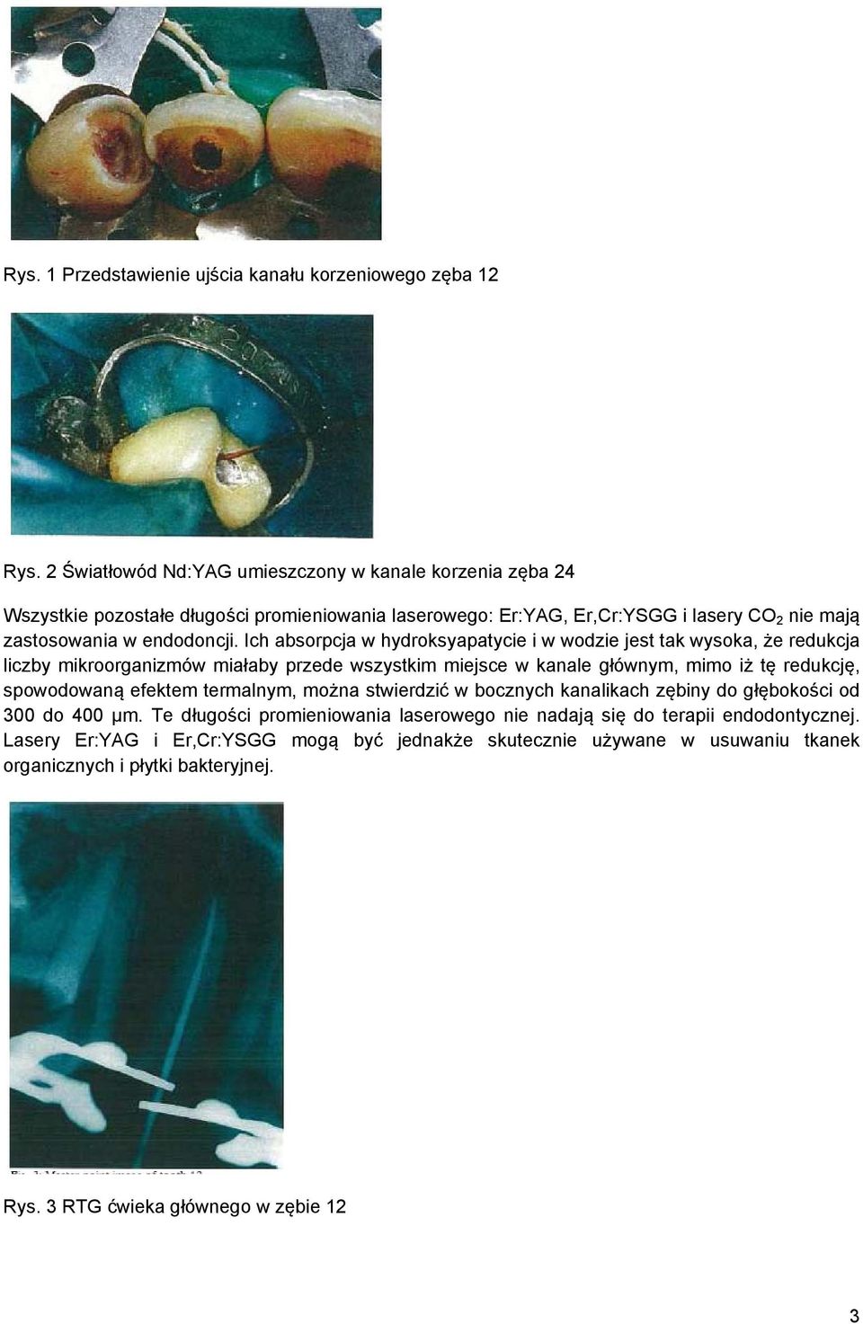 Ich absorpcja w hydroksyapatycie i w wodzie jest tak wysoka, że redukcja liczby mikroorganizmów miałaby przede wszystkim miejsce w kanale głównym, mimo iż tę redukcję, spowodowaną efektem